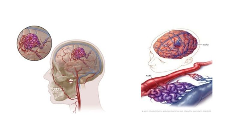 Mayapada Hospital Hadirkan Prosedur Modern Atasi AVM di Otak